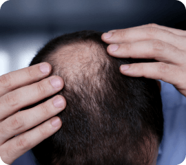Baldness and hair loss